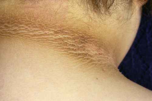 symptome acanthosis nigricans